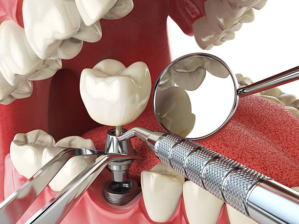 Best Emergency Root Canal Treatment in Laymantown, VA